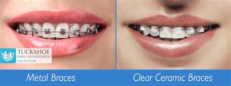 clear brackets or metal|ceramic braces vs clear brackets.